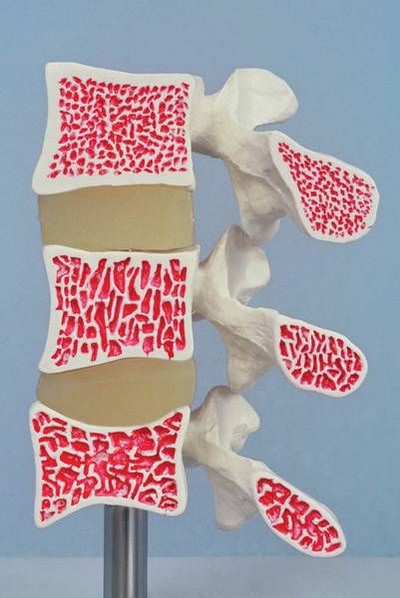 Osteoporose-Modell