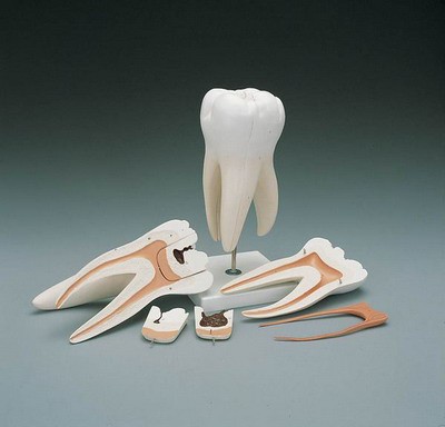 Giant Molar with Dental Caries, 15 times life-size, 6-part