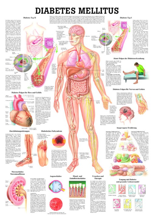 Diabetes mellitus 70 x 100 cm